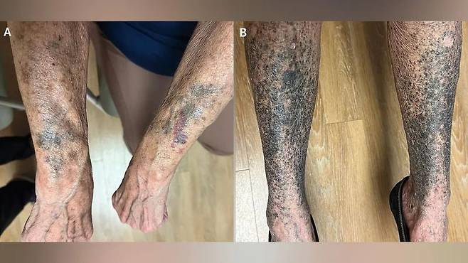 한 여성이 팔과 다리에 눈에 띄는 청회색 색소침착이 발생했다. 사진=The New England Journal of Medicine