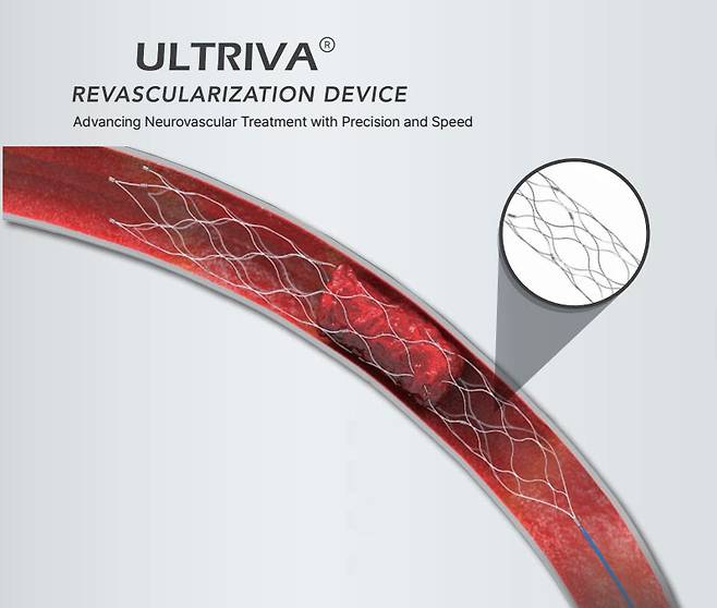 혈관계 의료기기 전문기업 엔벤트릭은 급성 뇌경색 치료용 스텐트 리트리버 ‘ULTRIVA’에 대해 식품의약품안전처 품목허가를 받았다.