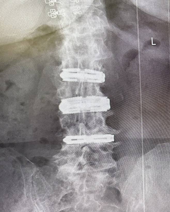 환자의 수술 후 전후방 X-ray 이미지. (엘앤케이바이오메드 제공)