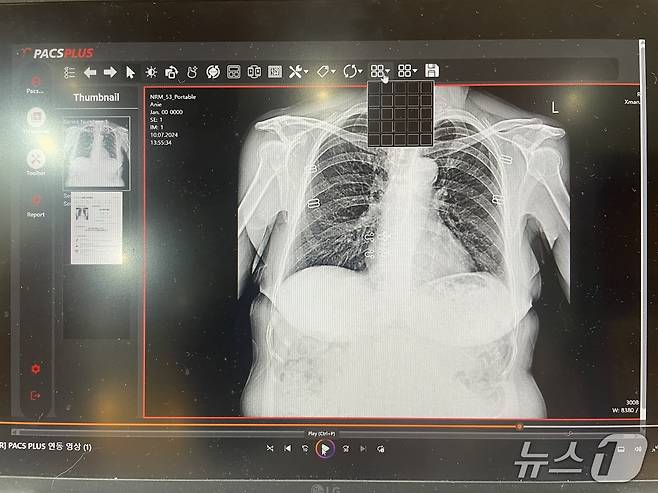 의료AI 기업 프로메디우스가 개발한 '오스테오 시그널(Osteo Signal)'. 흉부 엑스레이 사진 한 장으로 골다공증 위험도를 상세히 알려준다. 2026.08.19 ⓒ 뉴스1 임여익 기자