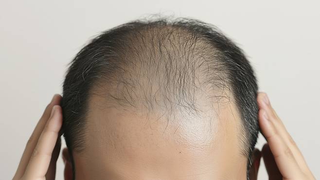 비만 치료제 위고비의 성분 '세마글루타이드'가 탈모 위험을 높일 수 있다는 연구 결과가 나왔다ㅣ출처: 클립아트코리아