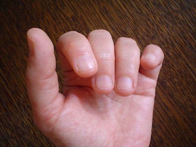 손톱을 5초간 꾹 눌렀다 뗐을 때 1~2초 이내에 원래의 붉은빛으로 돌아오지 않으면 혈액순환이나 심장에 이상이 있는 것일수도 있다. /게티이미지뱅크